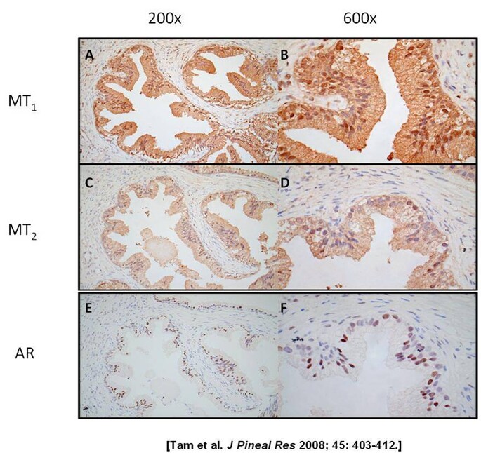 Expression of MT1, MT2 and androgen receptors in prostatic tissue showing nodular hyperplasia